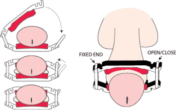 THE DRIBBLESTOP® MALE URINARY INCONTINENCE CLAMP